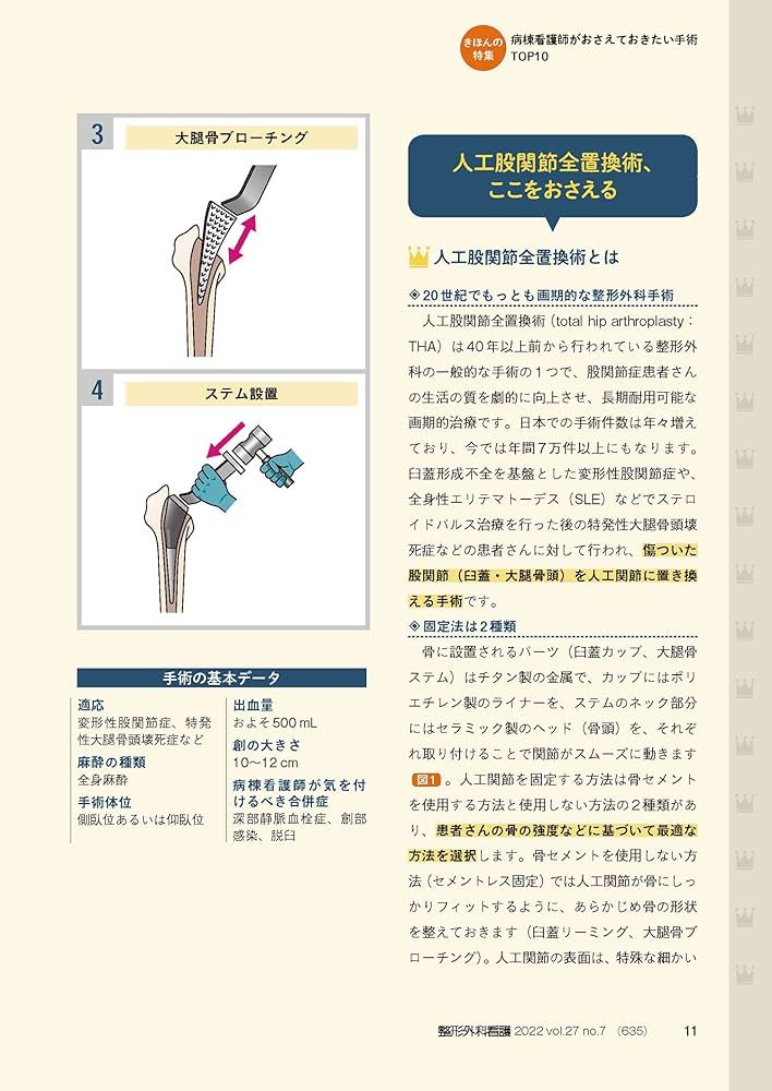 整形外科看護 2022年7月号(第27巻7号)特集:病棟看護師がおさえて